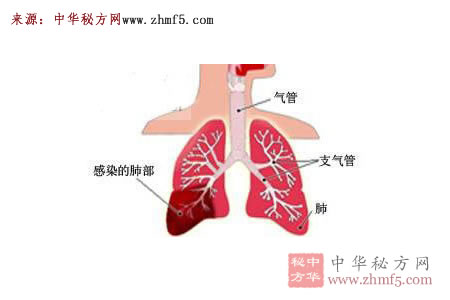 治肺炎驗(yàn)方二則