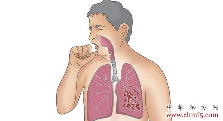 喝香油能使肺氣腫病情迅速緩解