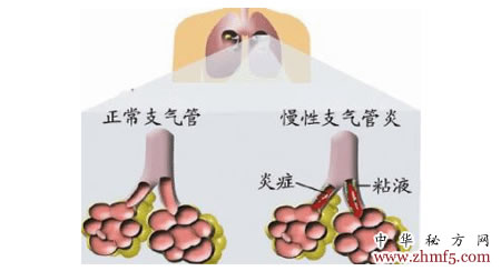 慢性支氣管炎