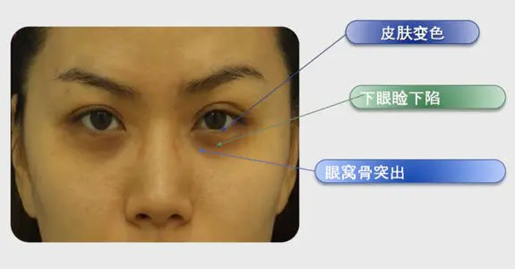什么習(xí)慣導(dǎo)致長黑眼圈 有效去除黑眼圈的4種方法