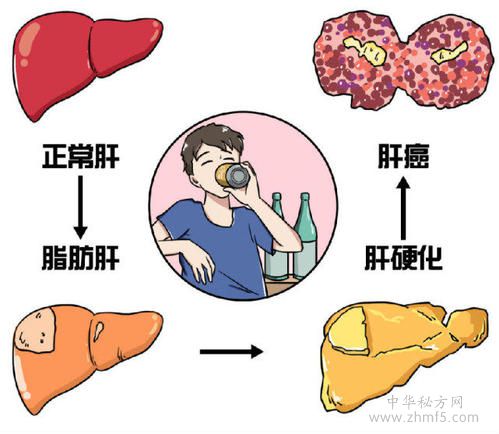 喝什么茶去脂肪肝 脂肪肝用什么中藥泡水喝好