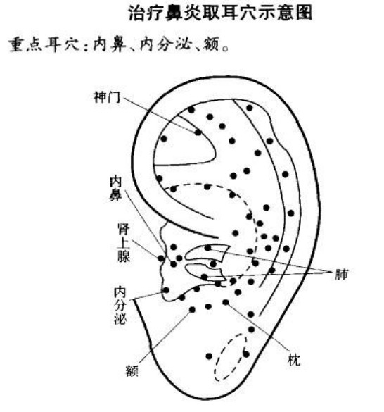 治療鼻炎取耳穴示意圖