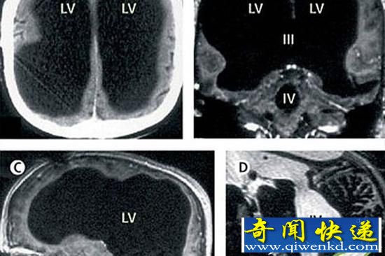 大腦神秘消失？美國男子大腦竟消失75%