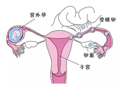 輸卵堵塞的癥狀_輸卵管積水能自愈嗎