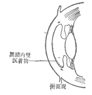 黑睛內(nèi)壁沉著物-側(cè)面觀