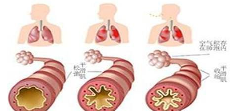 支氣管哮喘如何根治，試試這幾個(gè)哮喘偏方