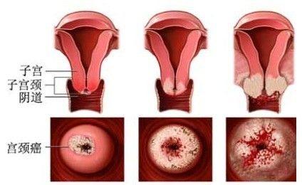 重度宮頸糜爛的癥狀_重度宮頸糜爛的癥狀有哪些圖片