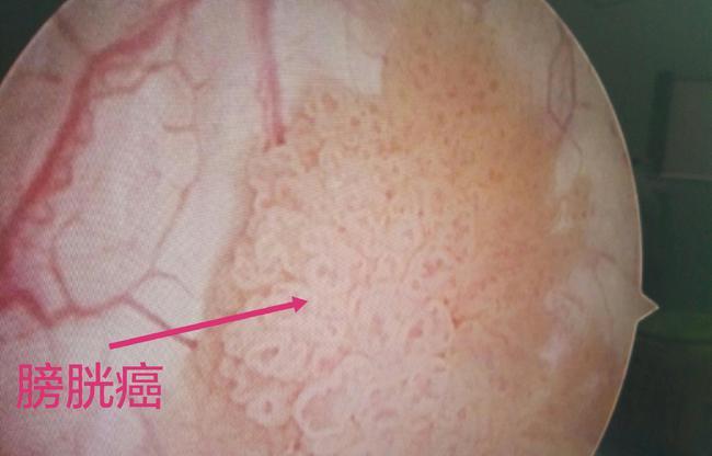 膀胱癌早期是什么癥狀,膀胱癌早期是什么癥狀會(huì)死人嗎