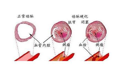 腦動脈硬化癥狀_腦動脈硬化癥狀的5個癥狀