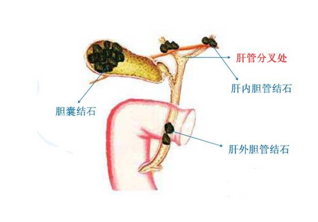 肝膽管結(jié)石癥狀(肝膽管結(jié)石有哪些癥狀出現(xiàn))