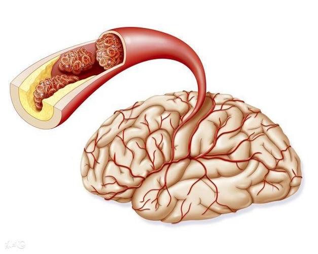 腦血管硬化的癥狀-腦血管硬化的癥狀有哪些