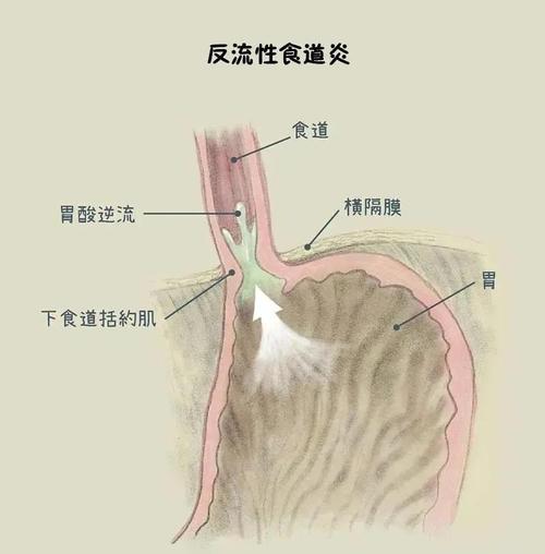 反流性食管炎癥狀_反流性食管炎癥狀及表現(xiàn)是什么一