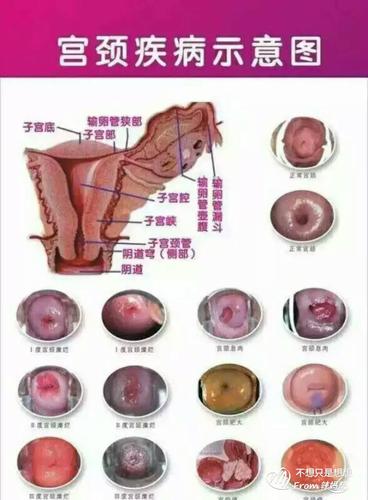 宮頸糜爛用微波治療副作用-宮頸糜爛用微波治療副作用大嗎