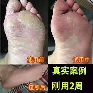 腳氣的癥狀圖片(腳氣的癥狀圖片抹什么藥)