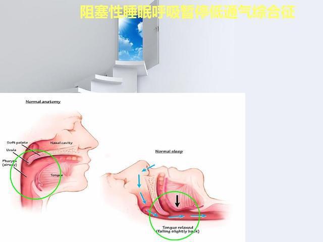 呼吸道異物阻塞的副作用_呼吸道異物阻塞的副作用是