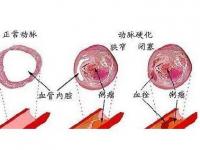 腦動脈硬化癥狀_腦動脈硬化癥狀的5個癥狀