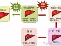 慢性肝炎癥狀(急性慢性肝炎癥狀)