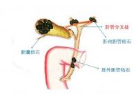 肝膽管結(jié)石癥狀(肝膽管結(jié)石有哪些癥狀出現(xiàn))