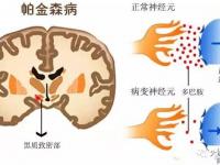 帕金森氏癥早期癥狀-帕金森氏癥早期癥狀是什么