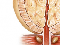 臨床前列腺癌的副作用-臨床前列腺癌的副作用有哪些