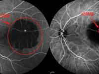 眼部ffa檢查副作用-眼部ffa檢查費用