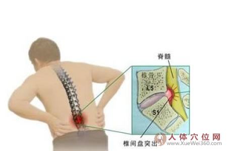 我的腰椎間盤突出用白面酒糊加拔罐治愈