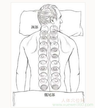 抑郁、煩悶別著急，用火罐拔走